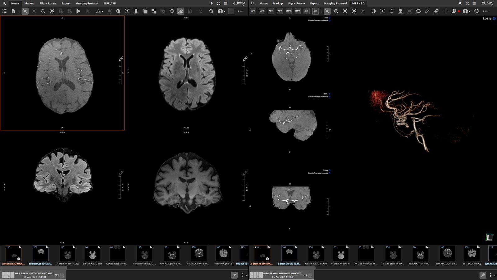 eUnity MPR and 3D view with a vascular reconstruction.