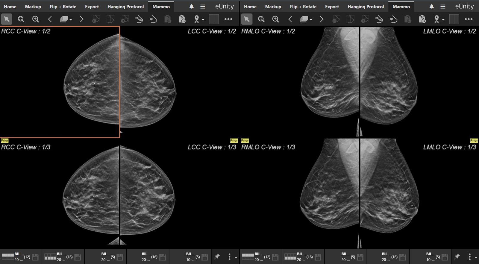 eUnity showing current and prior mammography views side by side.