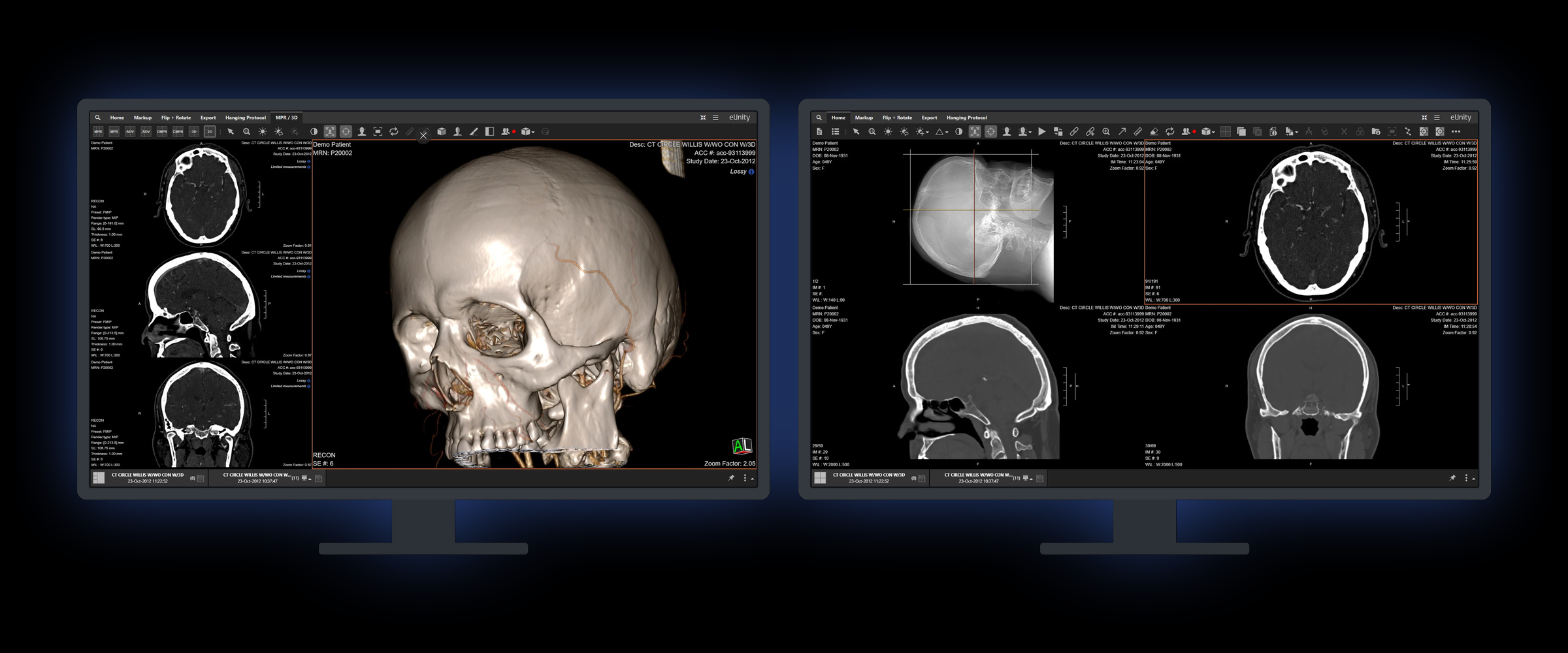 A two-monitor eUnity reading setup: multiplanar reformatting with a 3D volume render on the left screen and a four-pane CT review on the right, both running in a browser with nothing installed on either.