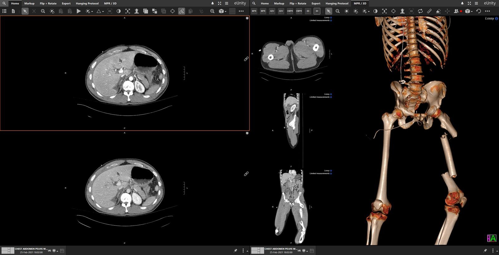 eUnity showing a whole-body CT volume rendering.
