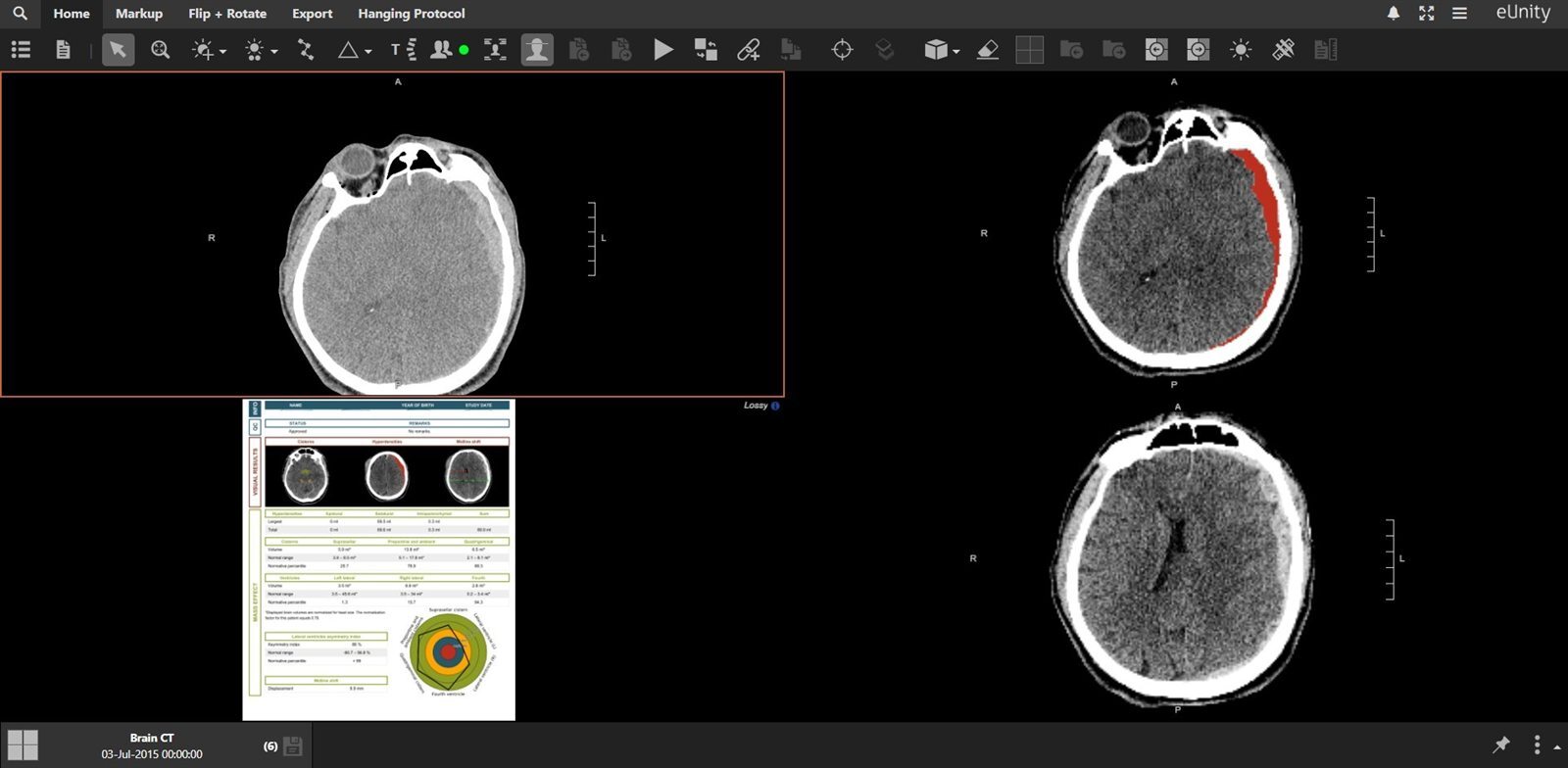 eUnity showing a brain CT with an AI segmentation overlay and a quantitative analysis report alongside it.