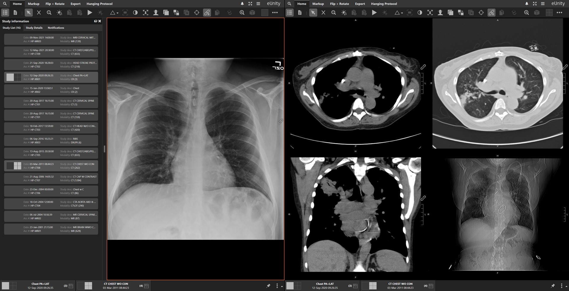 eUnity across two monitors showing a patient's study list of sixteen prior exams from 2001 to 2021 across CT, MR and radiography, with a chest radiograph and a four-pane chest CT open together.