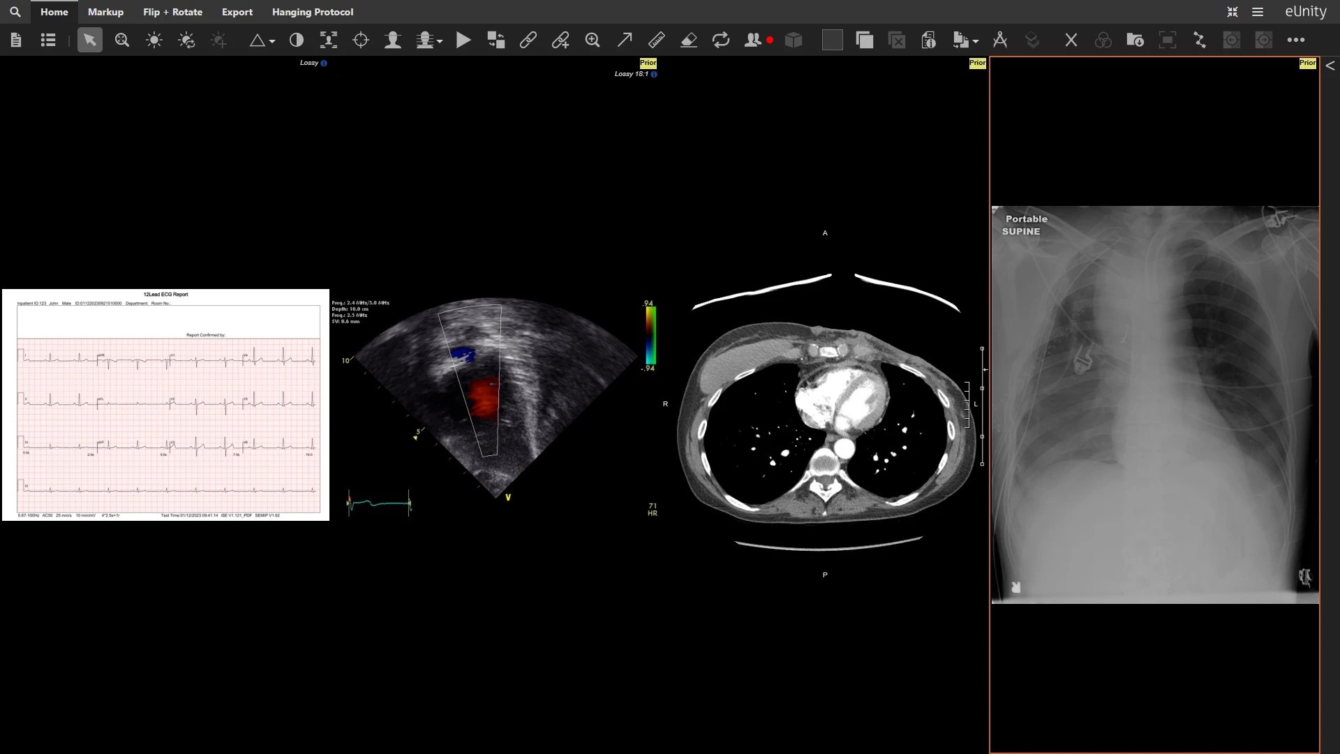 eUnity displaying a 12-lead ECG report, an echocardiogram with colour Doppler, an axial chest CT and a portable chest radiograph together in one hanging.