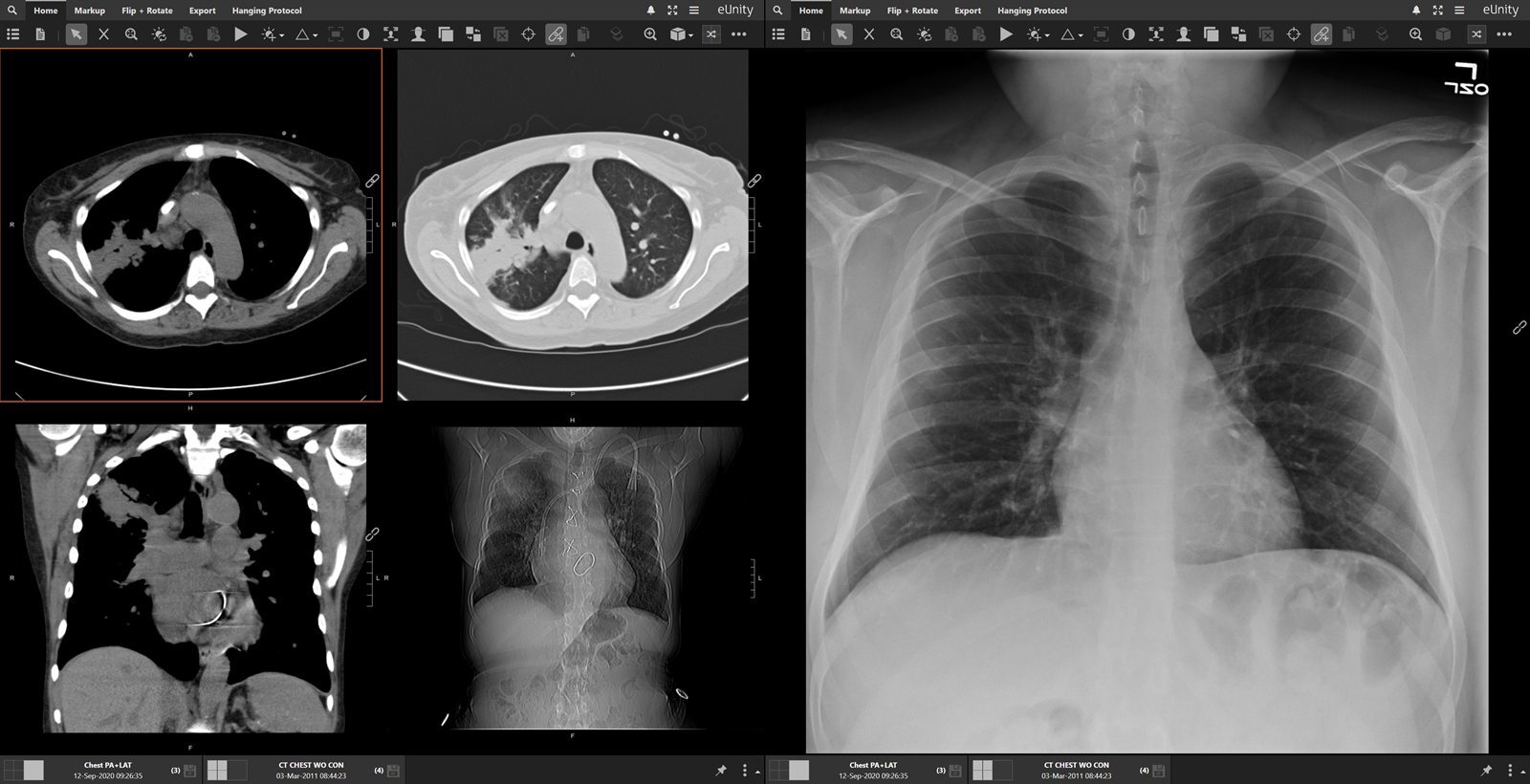 eUnity showing chest CT slices beside a chest radiograph across two displays.
