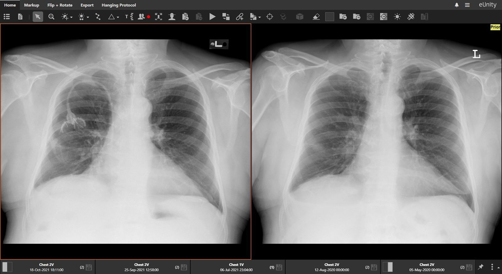 eUnity showing a current chest radiograph beside priors, with the prior series along the foot of the viewer.