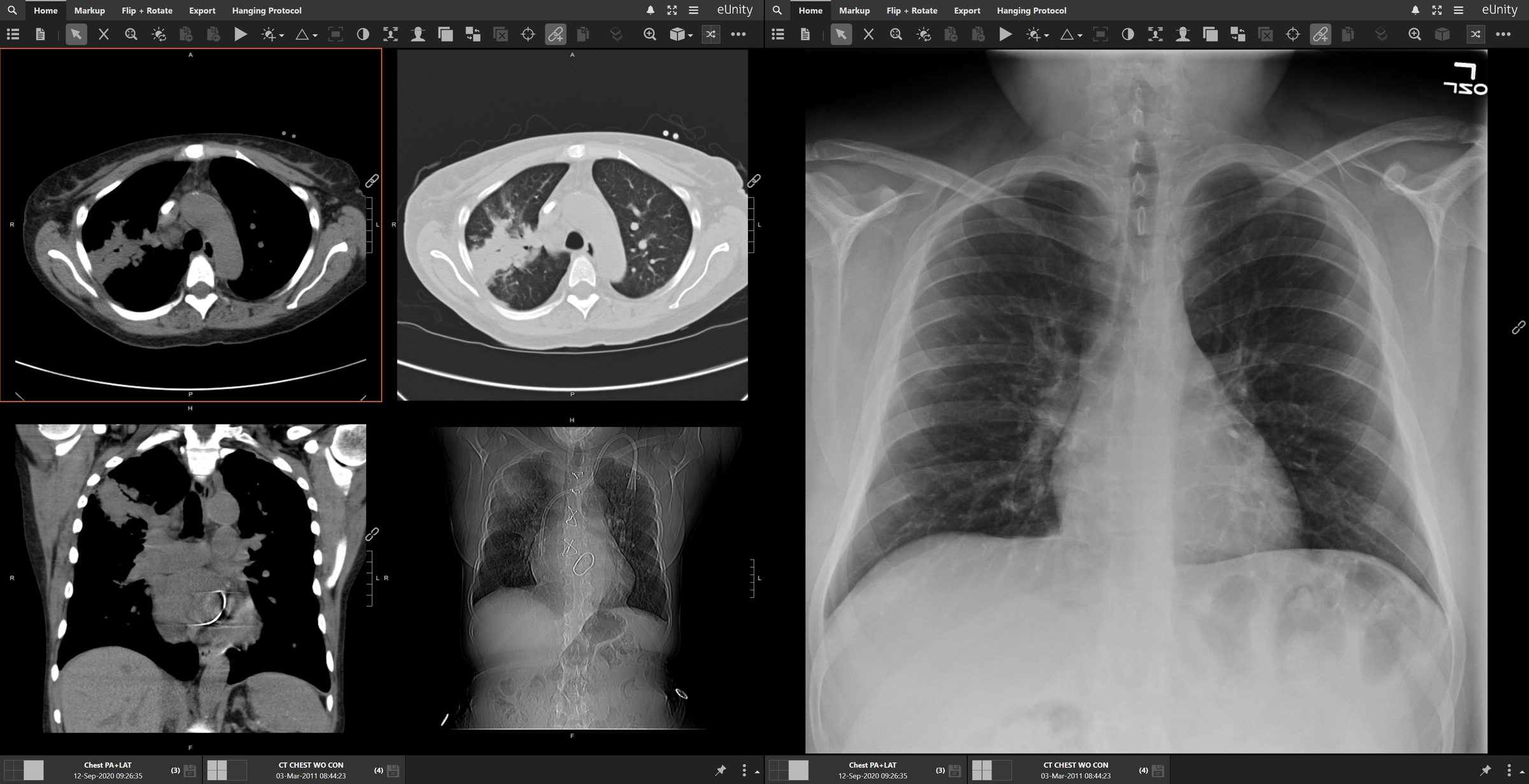 eUnity showing a chest CT series and a chest X-ray from different dates side by side in one view