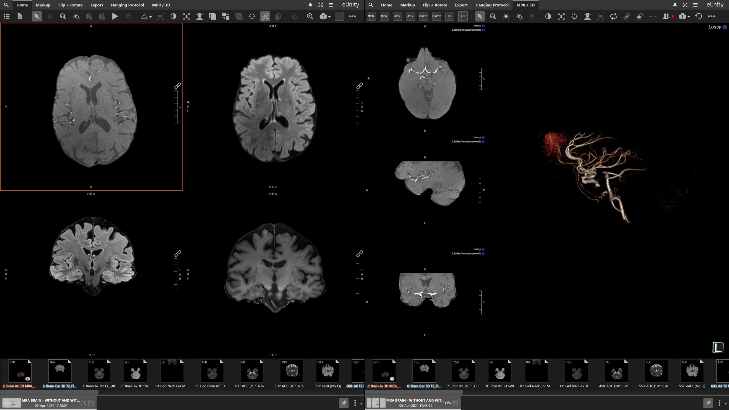 eUnity across two displays: brain MR series on the left, MPR and a 3D vessel rendering on the right