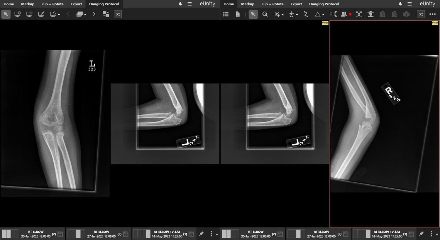 Pediatric elbow radiographs, opened in eUnity.
